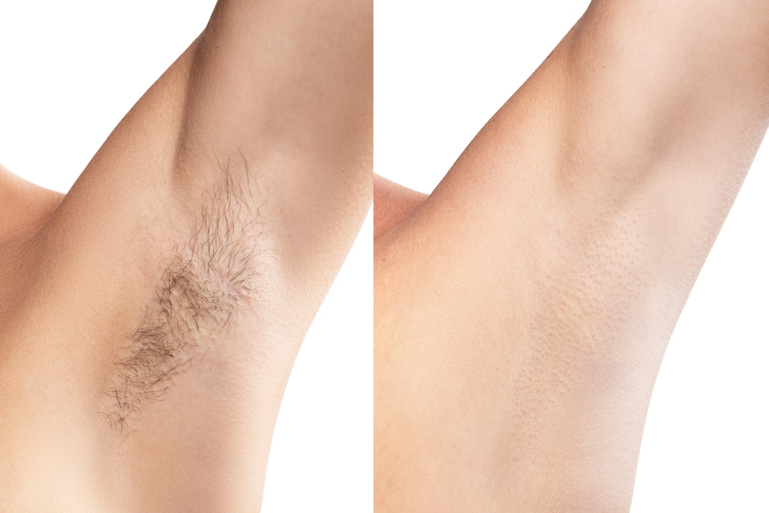 Comparison of Female Armpit after Hair Removal